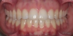 despues de ortodoncia con Clinica Tello